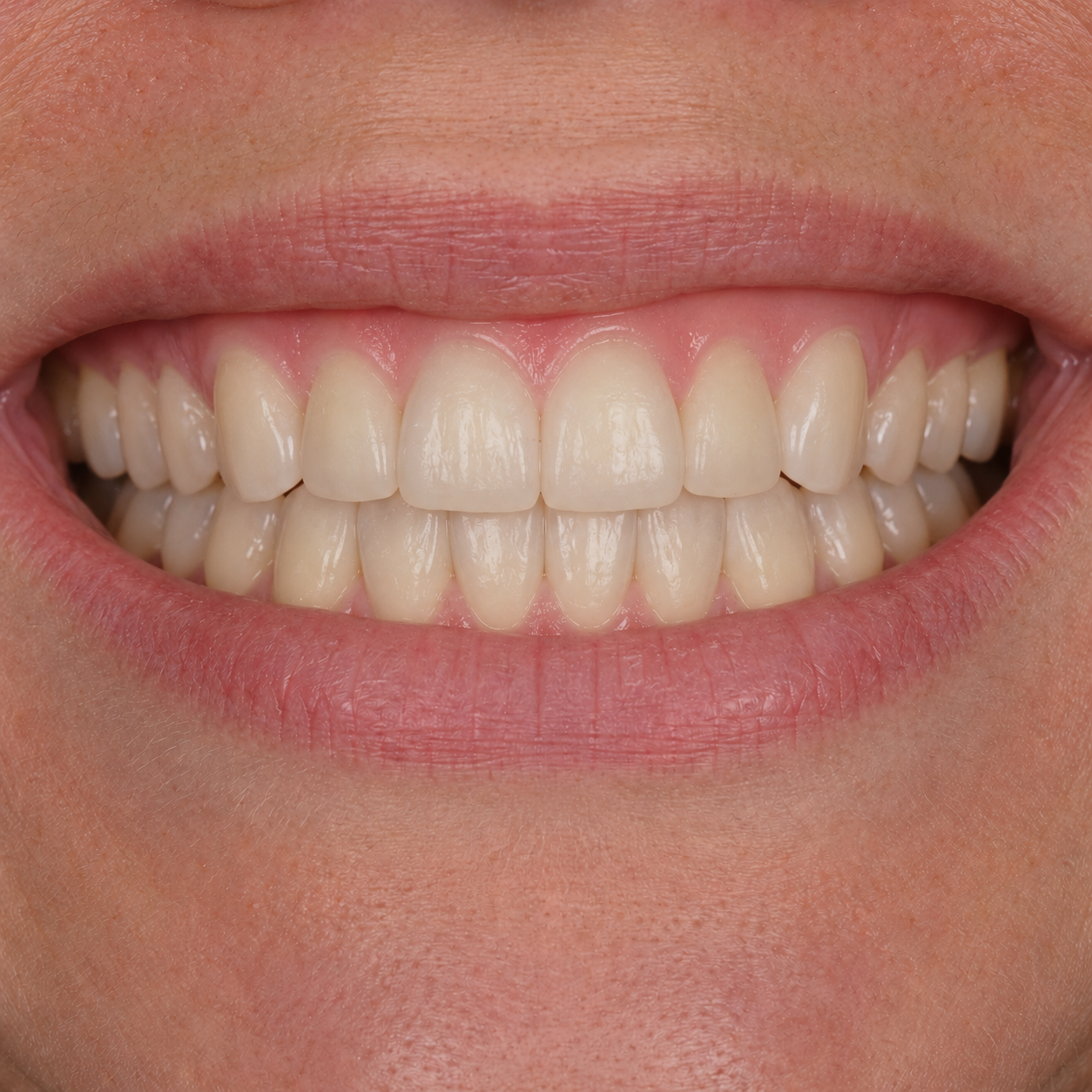 Clear Aligners — after